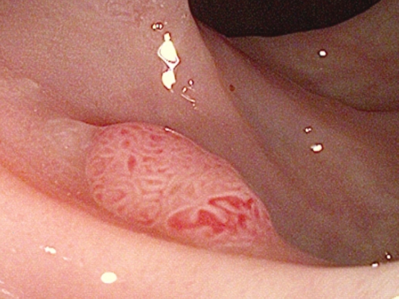 Adenom Resimleri Adenom Resimleri