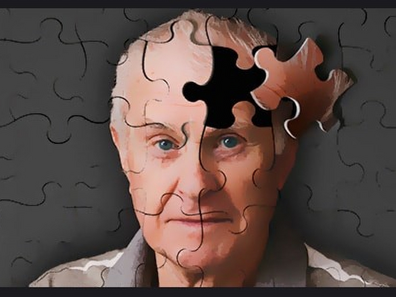 Alzheimer hastalığı Resim Alzheimer hastalığı Resim